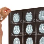 Management of MS relapses discussed