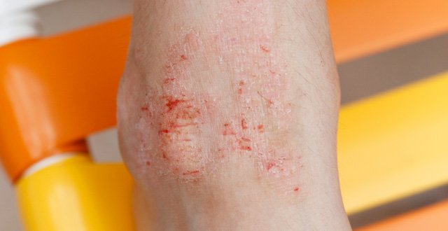 Eczema And Psoriasis