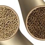 Quality-of-life needs to be better measured in osteoporosis
