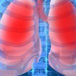 Focus on idiopathic pulmonary fibrosis (IPF) — Irish data, diagnosis and management