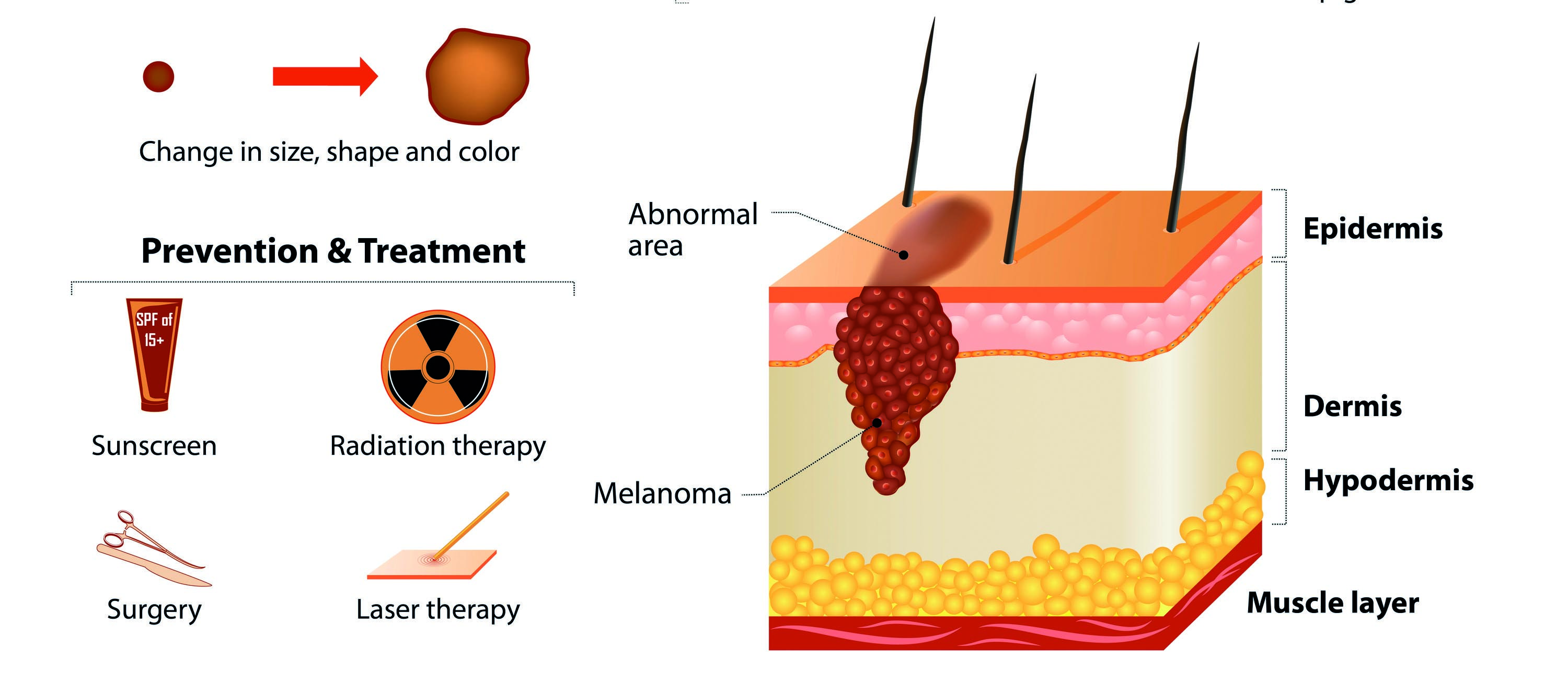 Treating actinic keratosis and Bowen's disease can help ...