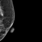 Direct access to mammography for GPs being examined