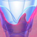 Routine second fine-needle aspiration to assess thyroid nodules not required in many cases