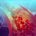 CPD Module- Cholesterol lowering diet