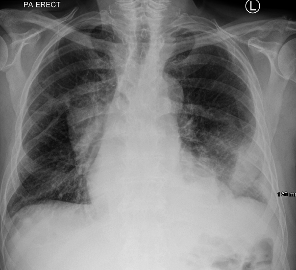 Managing malignant pleural effusion - Medical Independent