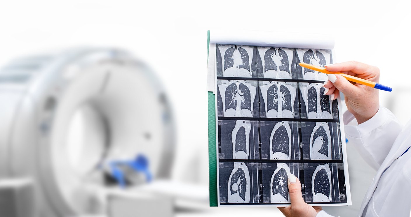 Lung cancer screening should be rolled out as a priority, ITS hears