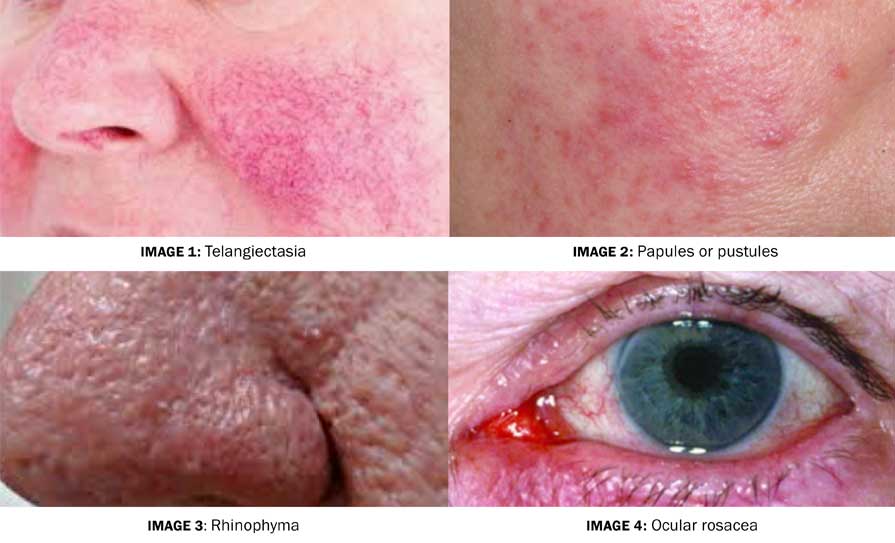 rosacea