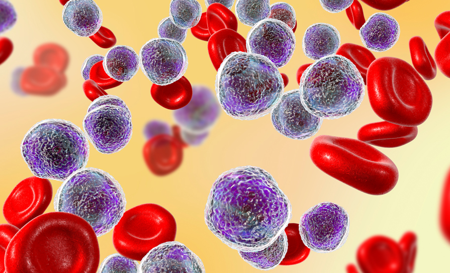 B-cell lymphoma