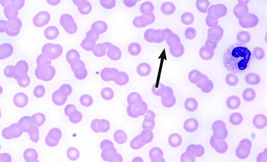 multiple myeloma