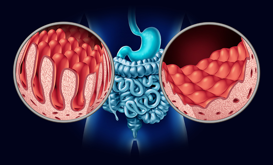 coeliac diease