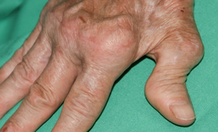 rheumatoid arthritis