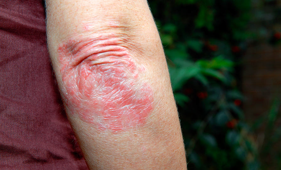 Psoriasis