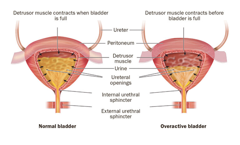 Navigating the complexities of overactive bladder - Medical Independent