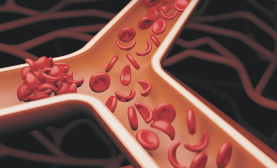 sickle cell disease