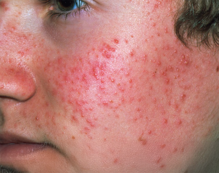 Acne