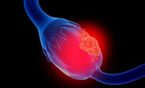 Ovarian cancer