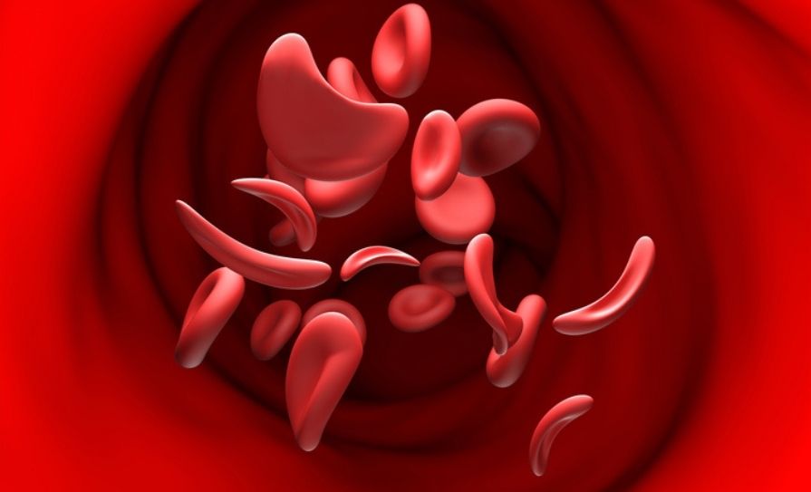 sickle cell