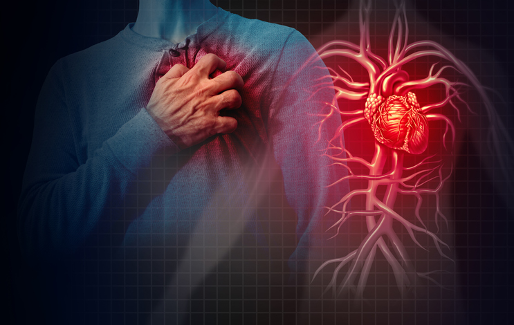 Myocardial Infarction