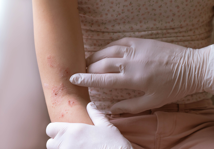 Impacts of eczema in children