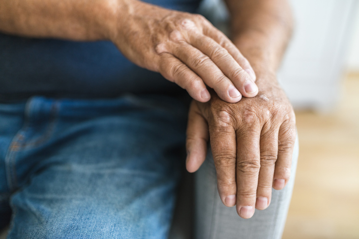 Psoriatic arthritis