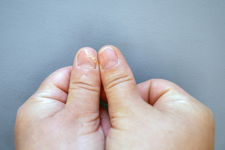 Nail detachment